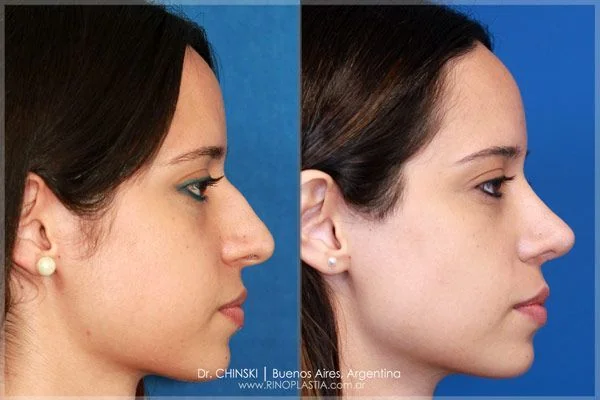 Antes e depois de rinoplastia – caso 234