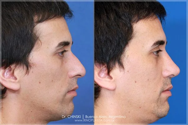 Antes e depois de rinoplastia – caso 235