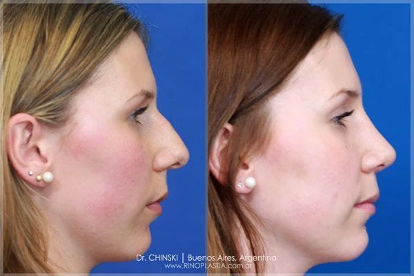 Rhinoplasty before and after – case 236