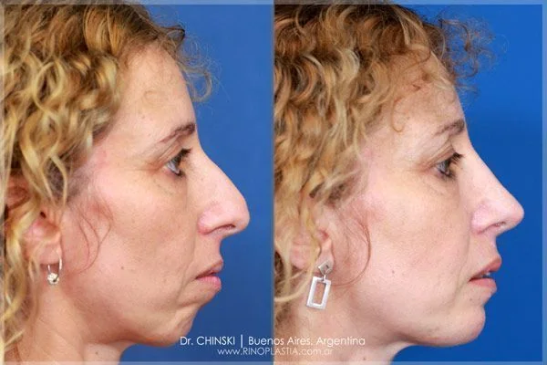 Antes e depois de rinoplastia – caso 237