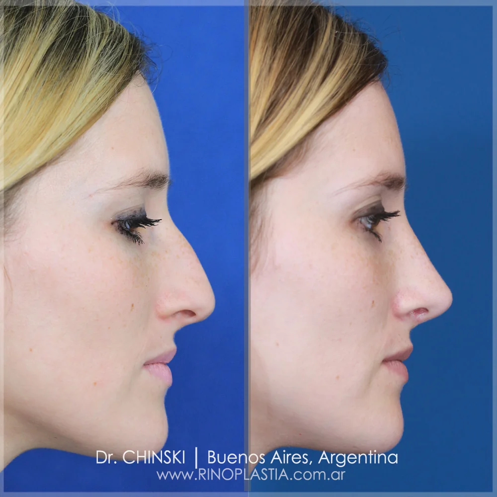 Antes e depois de rinoplastia – caso 238
