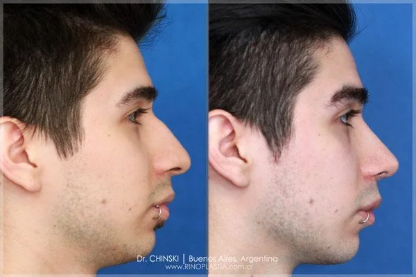 Rhinoplasty before and after – case 239