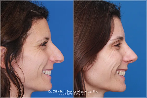 Antes y después de rinoplastia – caso 240