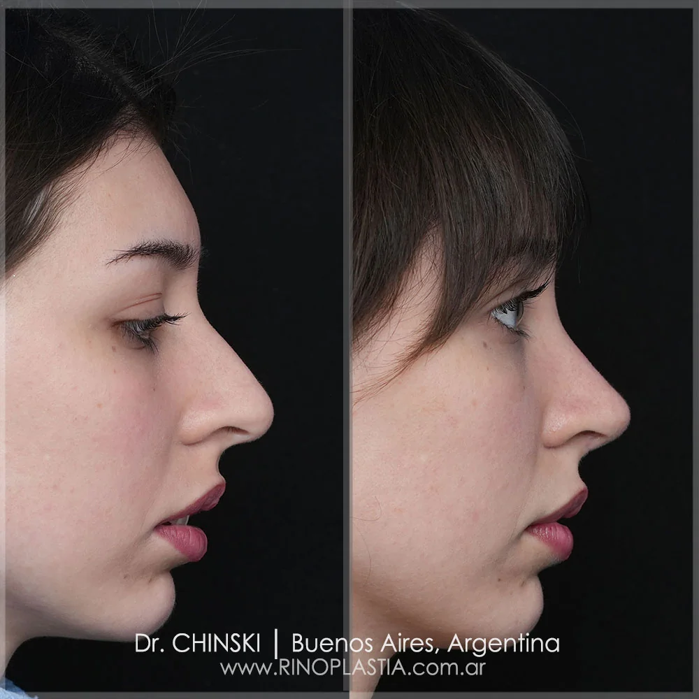 Rhinoplasty before and after – case 26