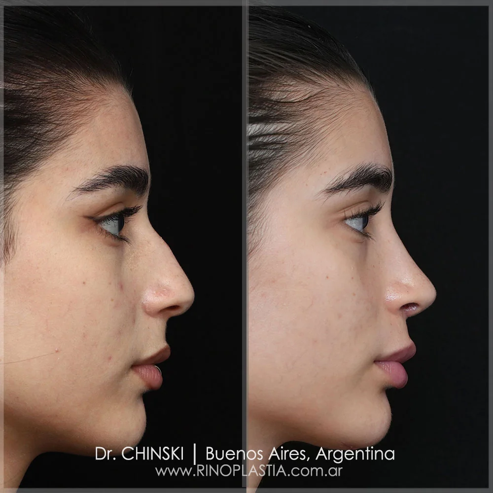 Rhinoplasty before and after – case 27
