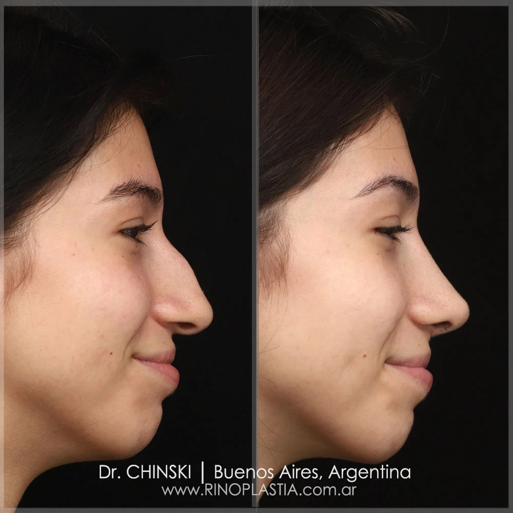 Antes e depois de rinoplastia – caso 28