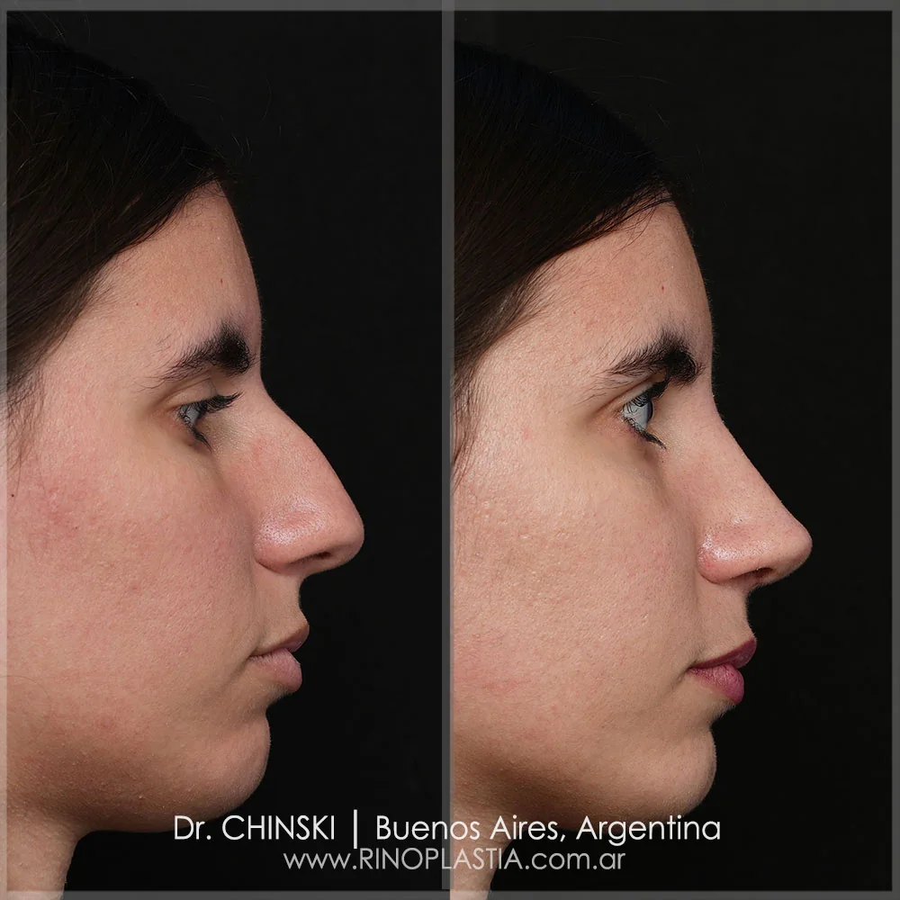 Antes e depois de rinoplastia – caso 29