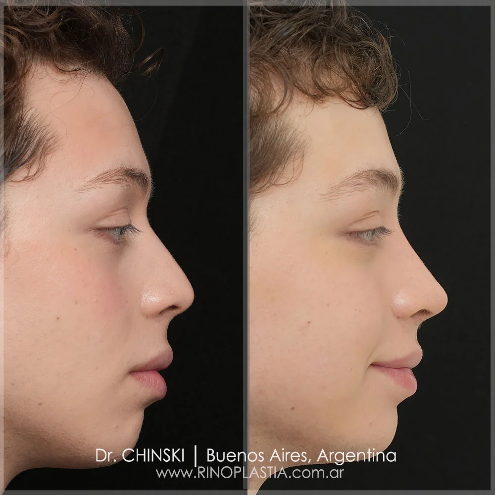 Antes y después de rinoplastia – caso 3