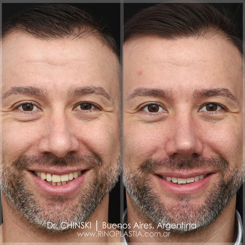 Antes e depois de rinoplastia – caso 30
