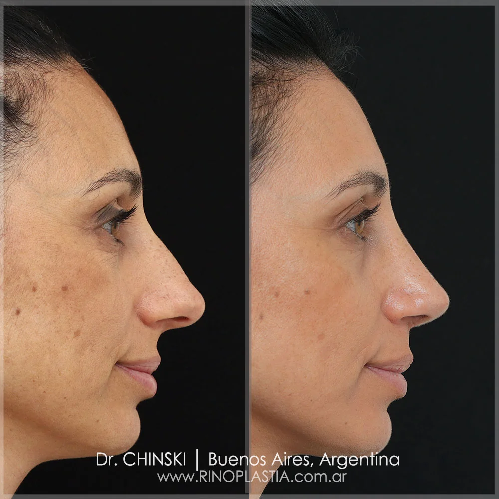 Antes e depois de rinoplastia – caso 31