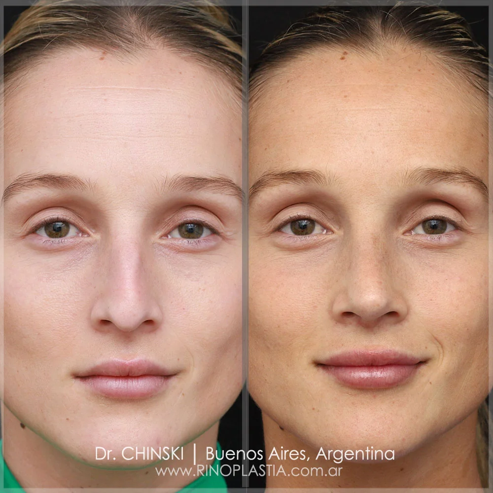 Antes e depois de rinoplastia – caso 32