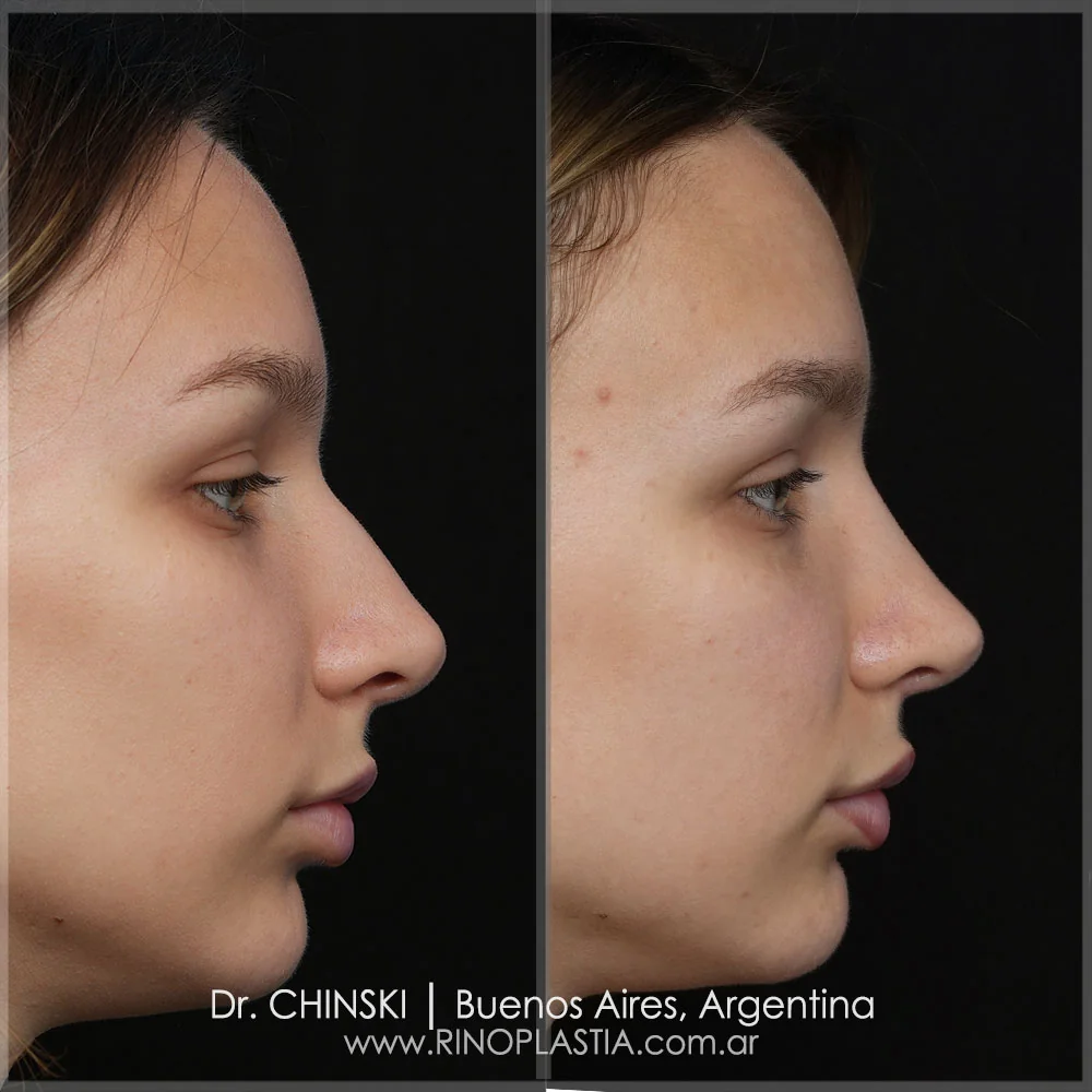Antes e depois de rinoplastia – caso 33