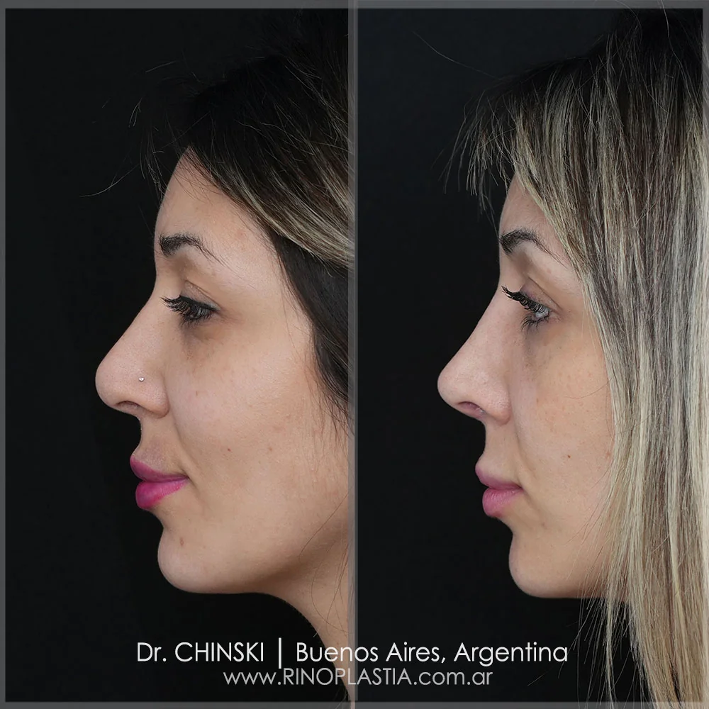 Rhinoplasty before and after – case 34