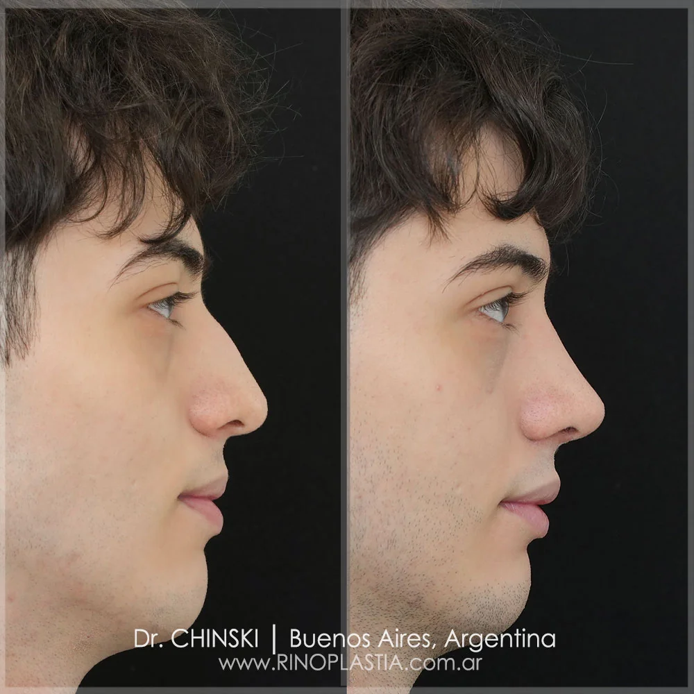 Antes e depois de rinoplastia – caso 35