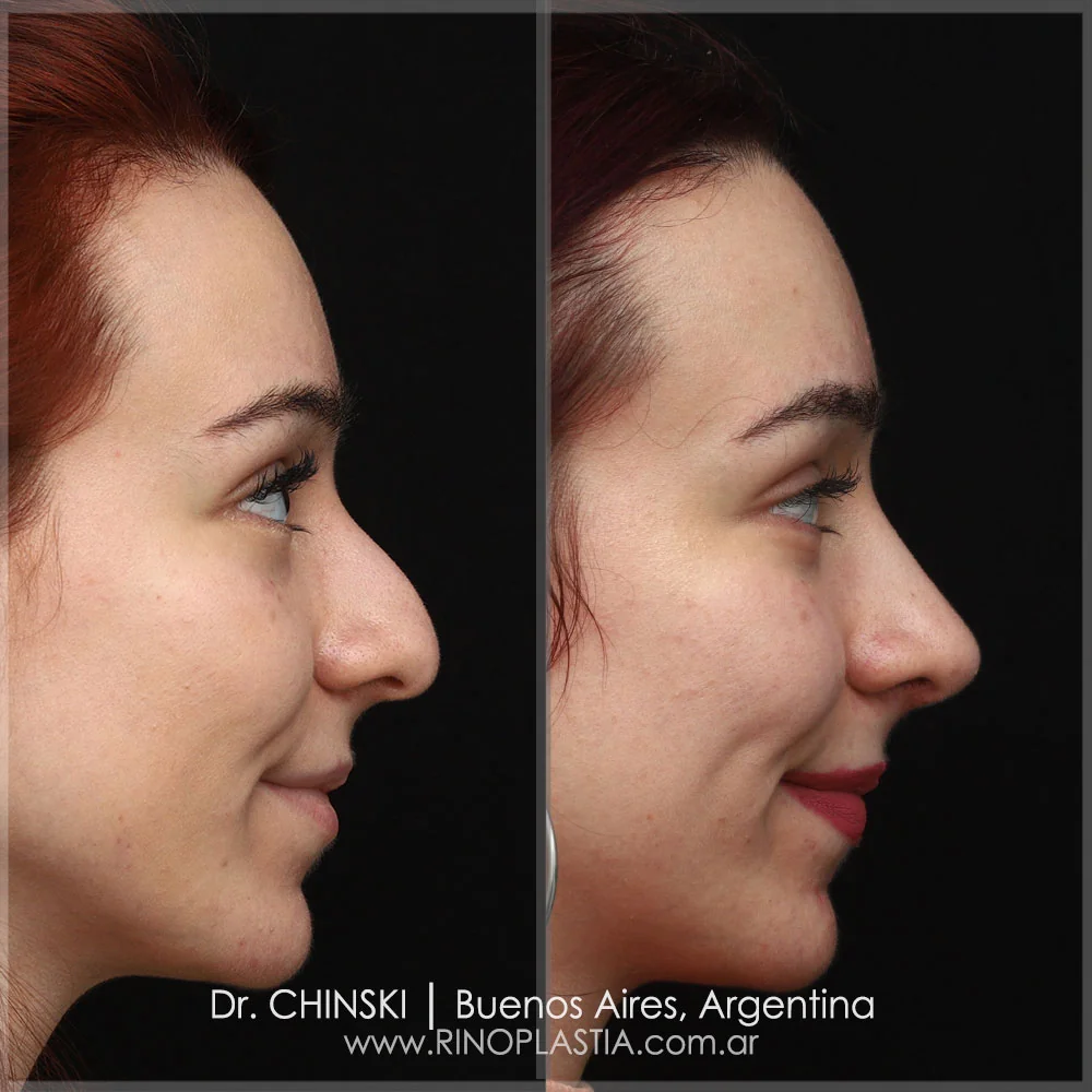 Antes e depois de rinoplastia – caso 36