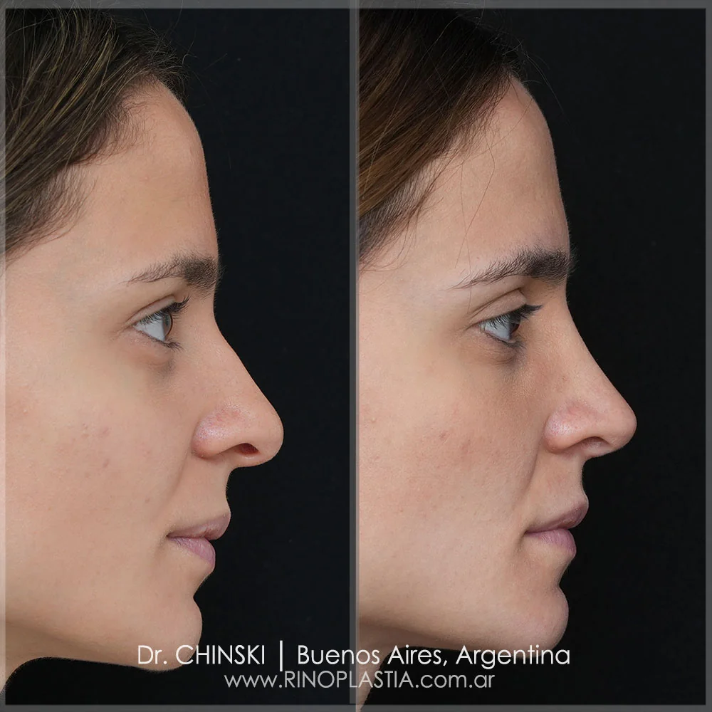 Antes e depois de rinoplastia – caso 38