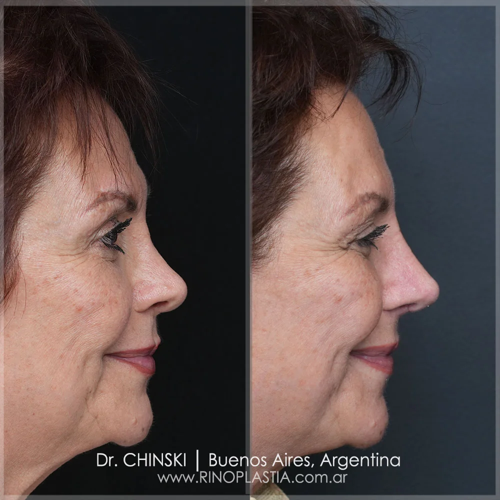 Rhinoplasty before and after – case 39