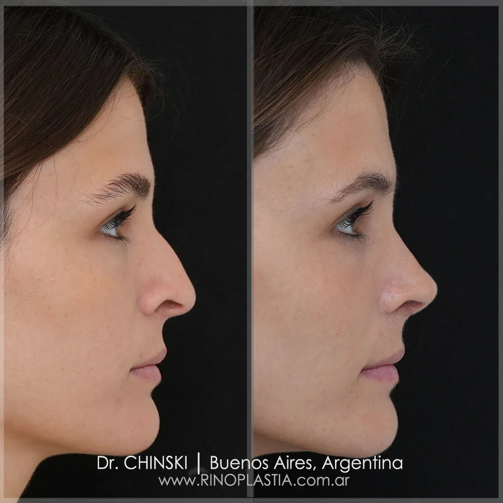 Antes y después de rinoplastia – caso 4