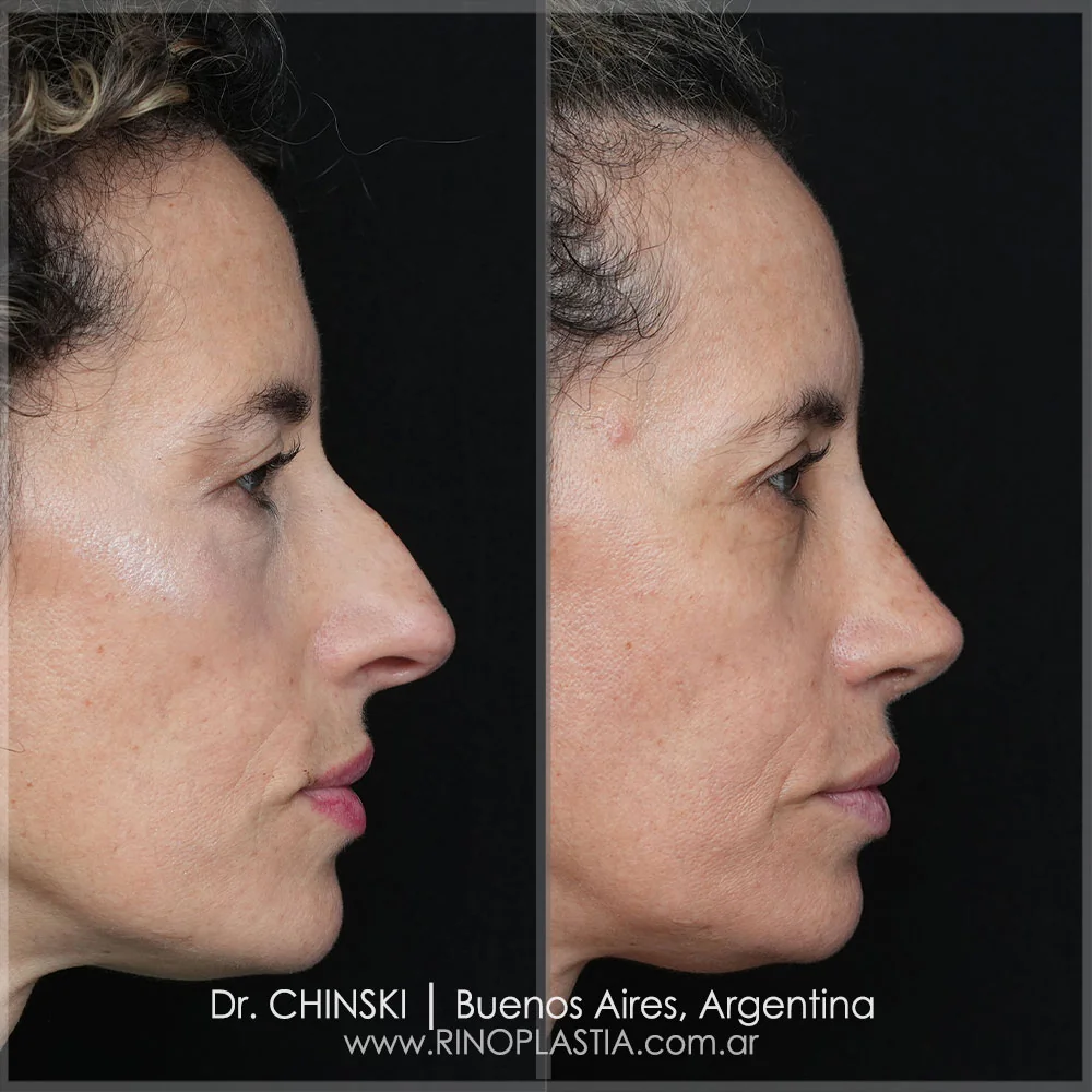Antes e depois de rinoplastia – caso 40