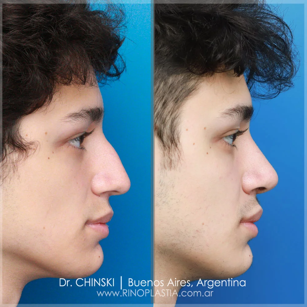 Antes e depois de rinoplastia – caso 41