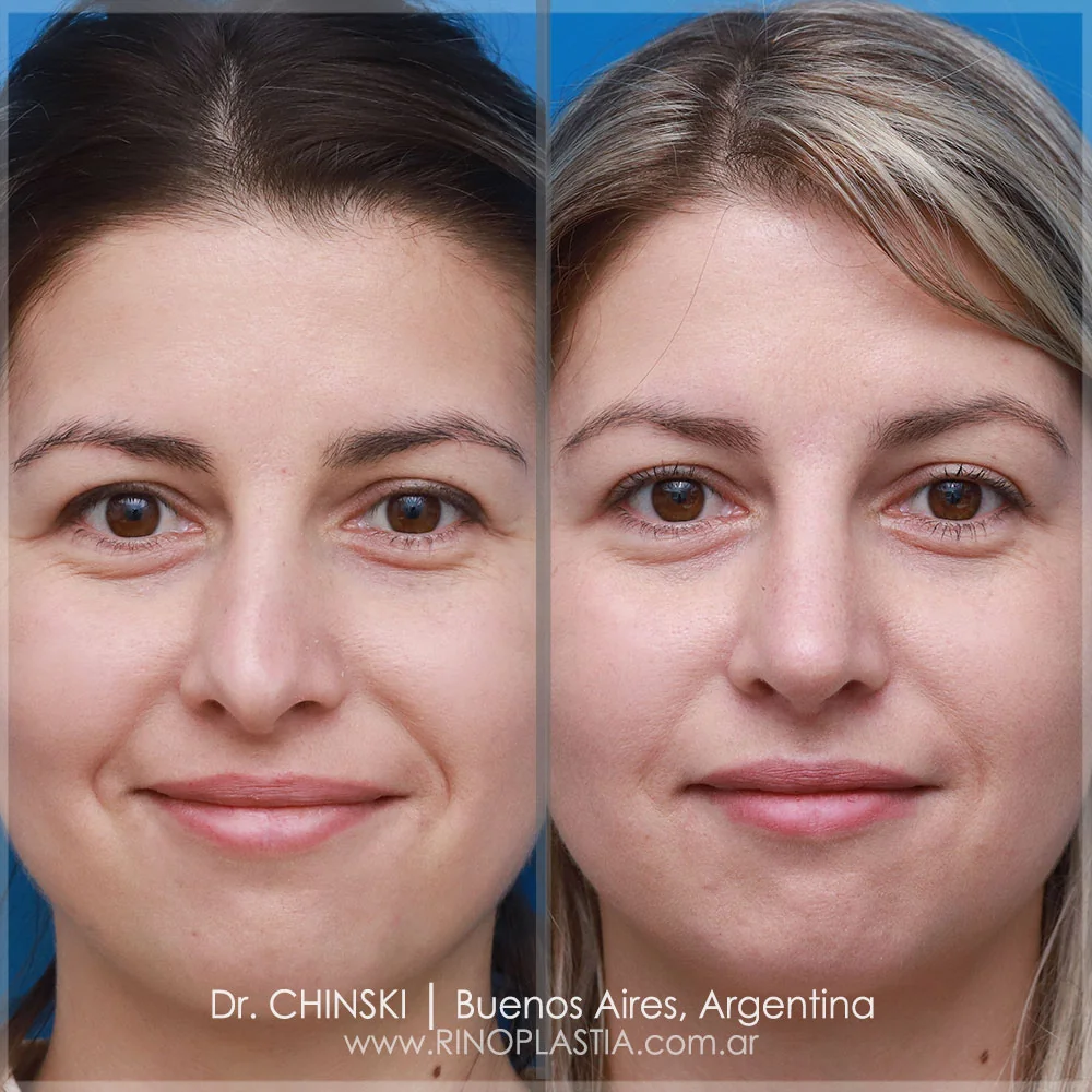 Antes e depois de rinoplastia – caso 42