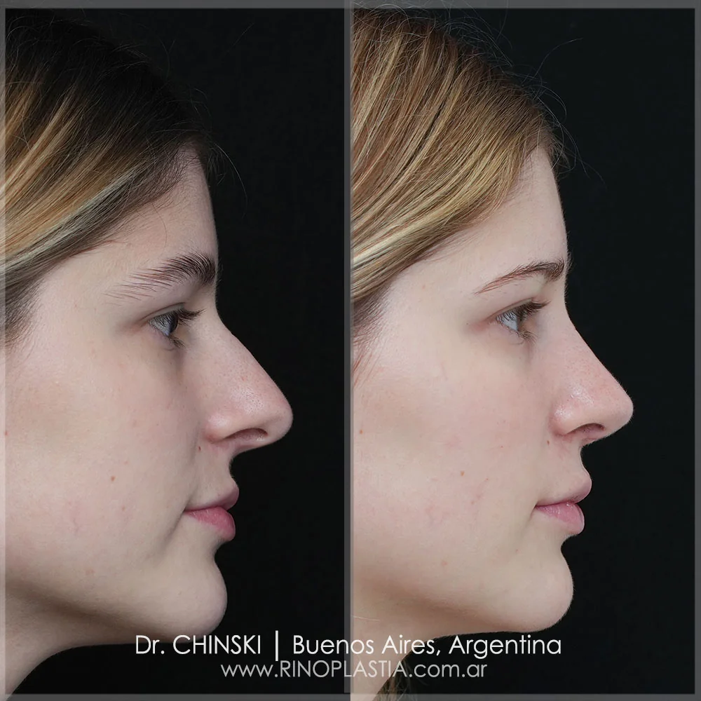 Antes e depois de rinoplastia – caso 43