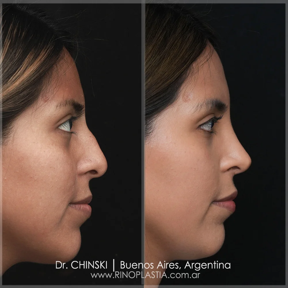Antes e depois de rinoplastia – caso 44