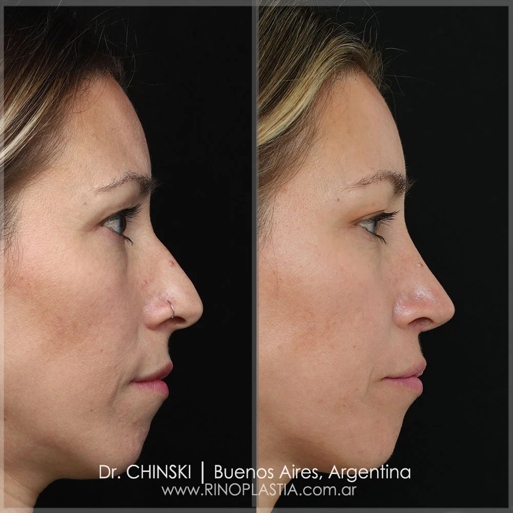 Antes e depois de rinoplastia – caso 45