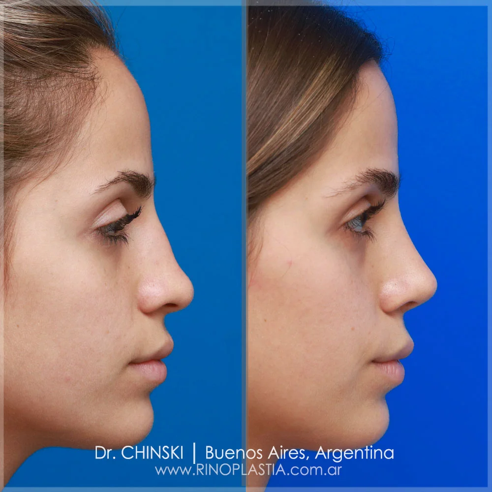 Rhinoplasty before and after – case 46