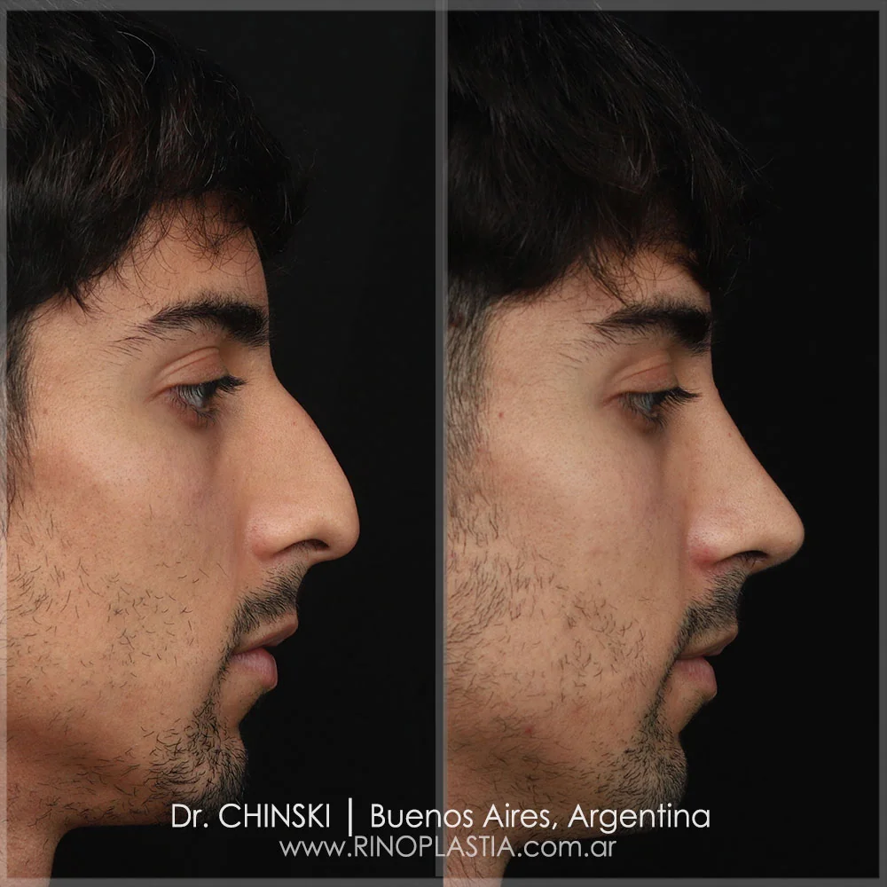Antes e depois de rinoplastia – caso 47