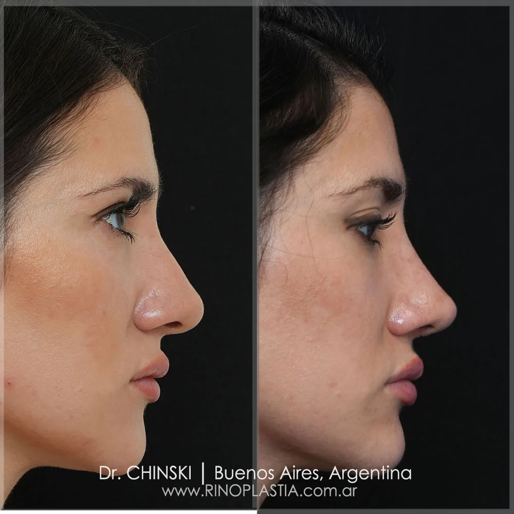 Antes e depois de rinoplastia – caso 48