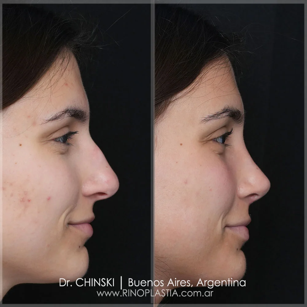 Antes e depois de rinoplastia – caso 49