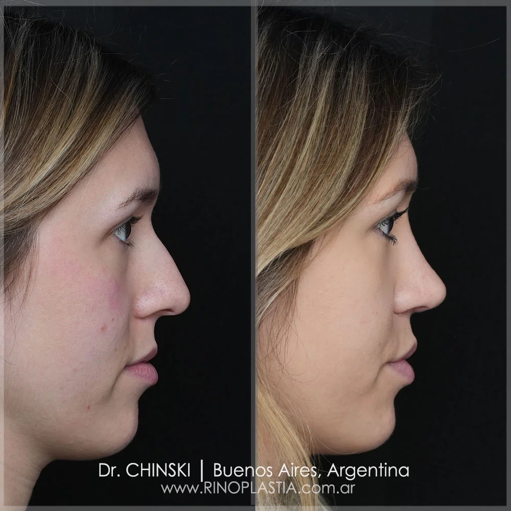 Antes e depois de rinoplastia – caso 50