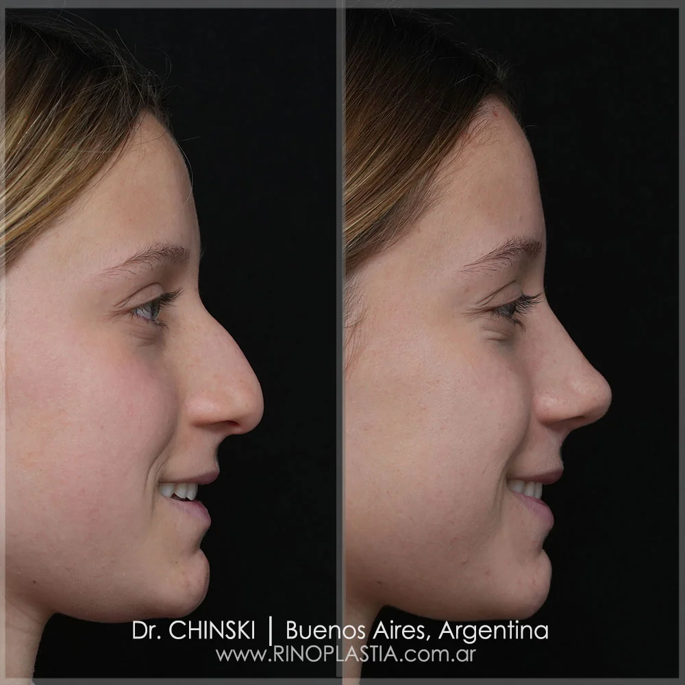 Antes e depois de rinoplastia – caso 51