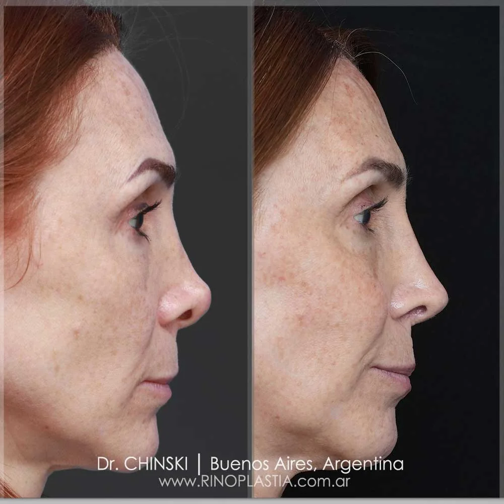 Rhinoplasty before and after – case 52
