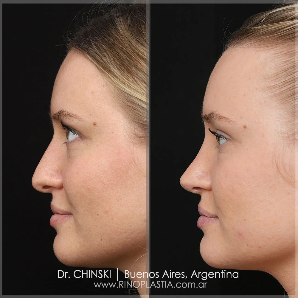 Antes e depois de rinoplastia – caso 53