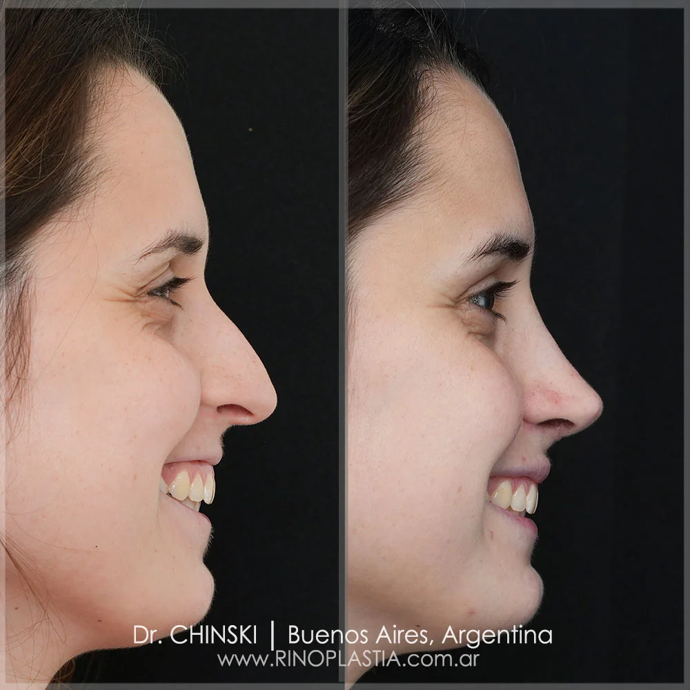 Antes e depois de rinoplastia – caso 54
