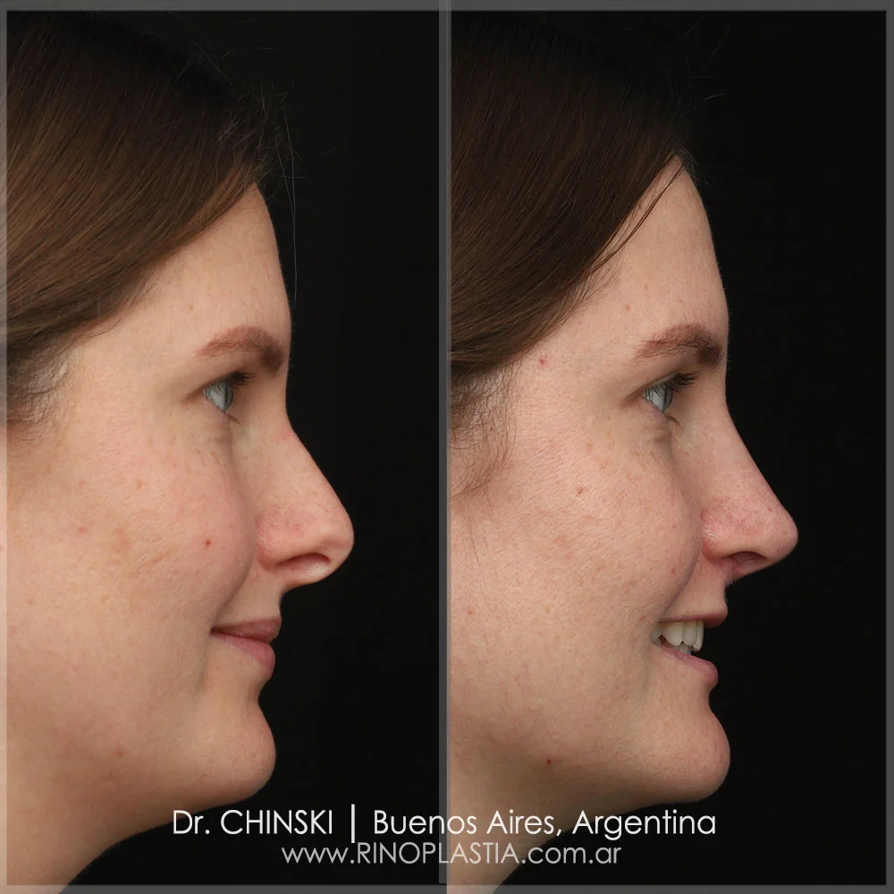 Rhinoplasty before and after – case 55