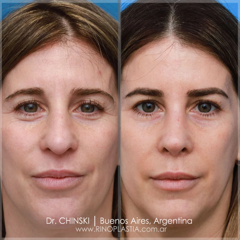 Antes e depois de rinoplastia – caso 56
