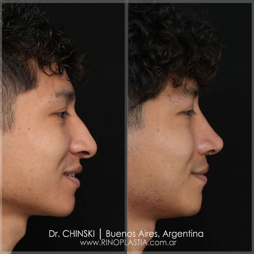 Antes e depois de rinoplastia – caso 57