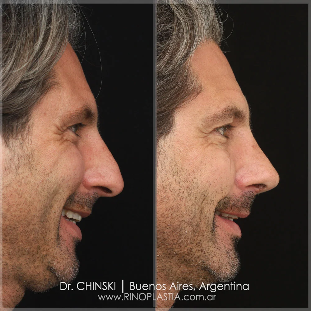 Antes e depois de rinoplastia – caso 58