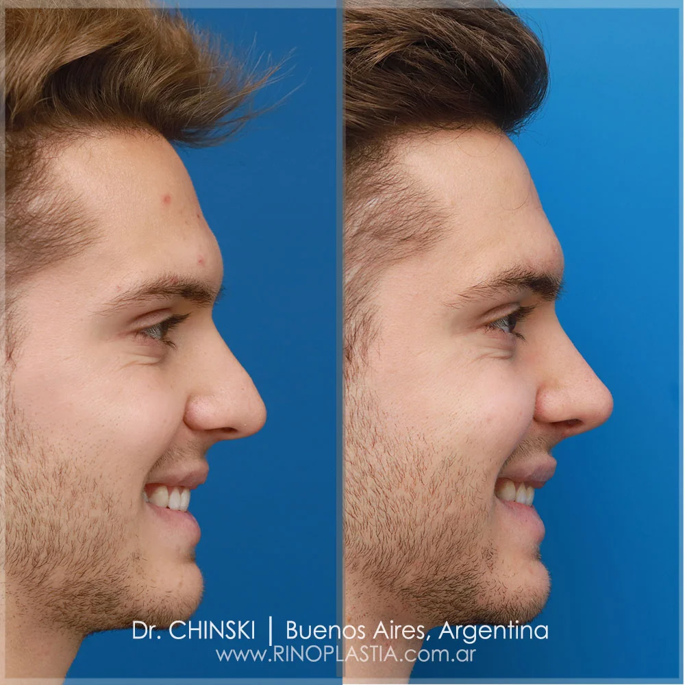 Antes e depois de rinoplastia – caso 59