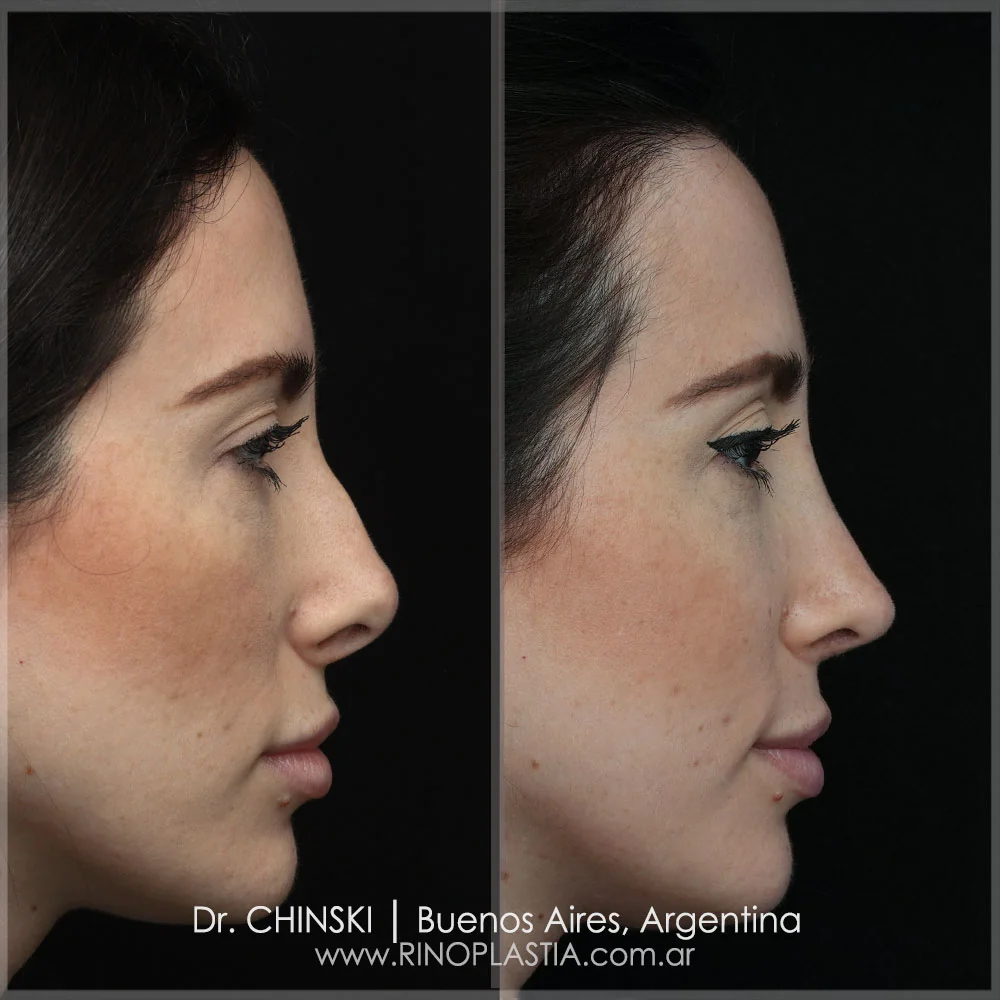 Antes y después de rinoplastia – caso 6