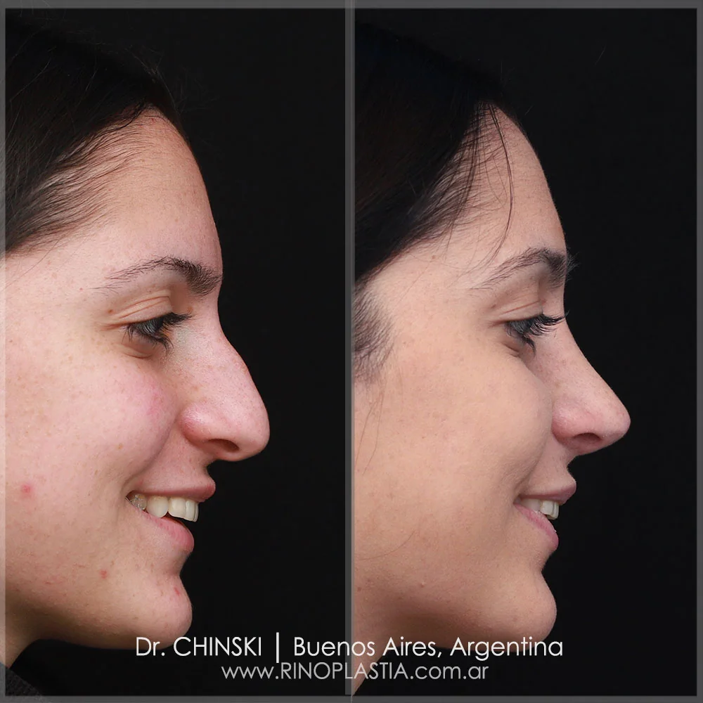 Antes e depois de rinoplastia – caso 60