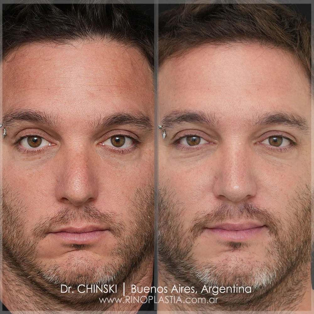 Antes y después de rinoplastia – caso 61