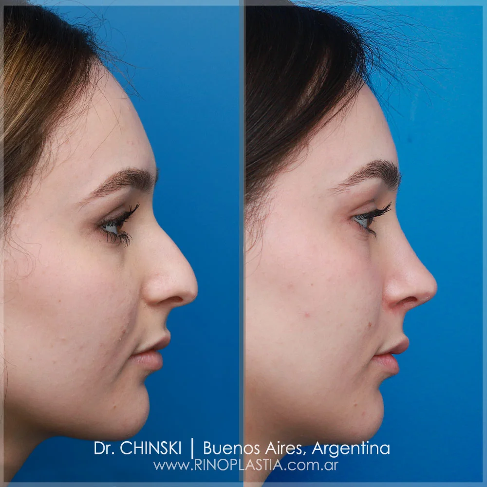 Antes e depois de rinoplastia – caso 62