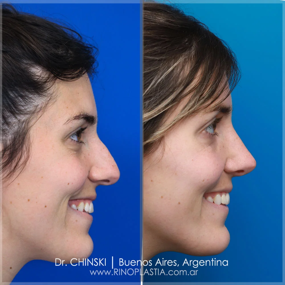 Antes e depois de rinoplastia – caso 63