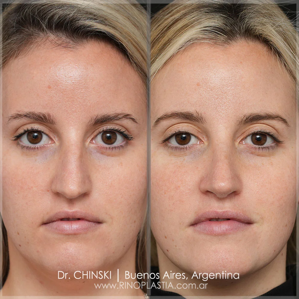 Antes e depois de rinoplastia – caso 64