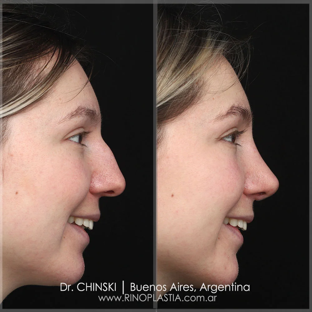 Antes e depois de rinoplastia – caso 65