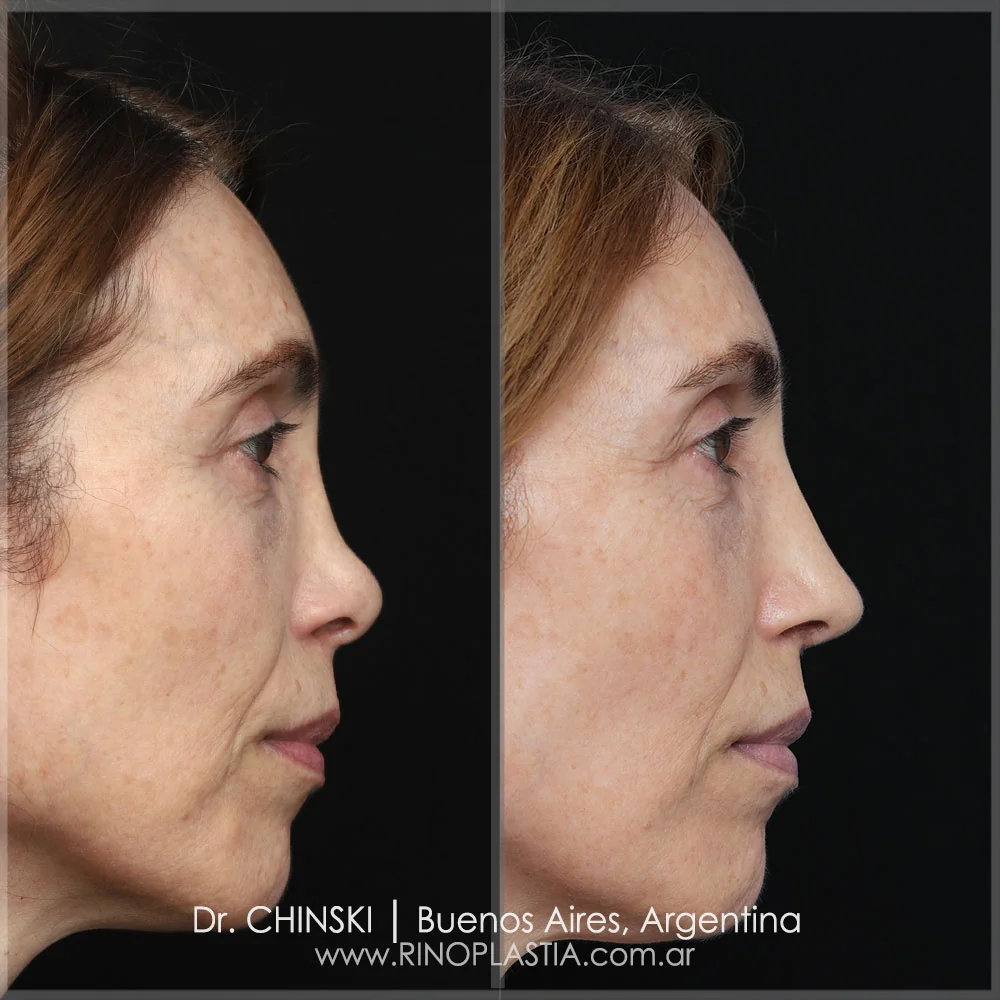 Rhinoplasty before and after – case 66